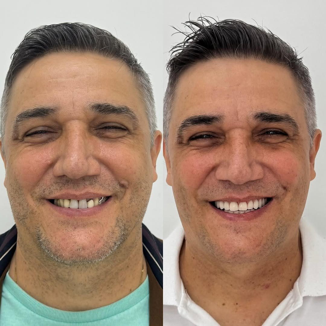 antes e depois 1