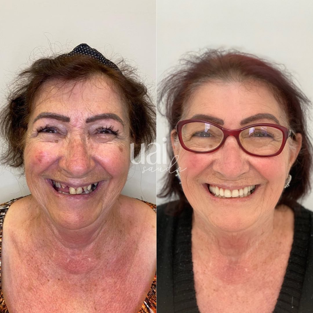 antes e depois2